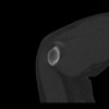 SPORK, NICO - 22.03.1976 - 02.08.2022 - CT obere Extremität - 17:59:07